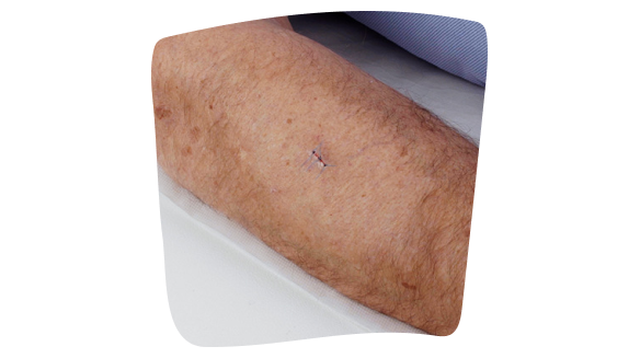 Imagen de una cicatriz pequeña en el brazo Imagen de una cicatriz pequeña en el brazo